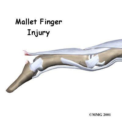 Mallet Finger (Long Extensor Tendon) | 🩺Singapore Sports & Orthopaedic ...