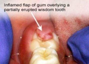 When Should Wisdom Teeth Be Removed? - Plaza Dental