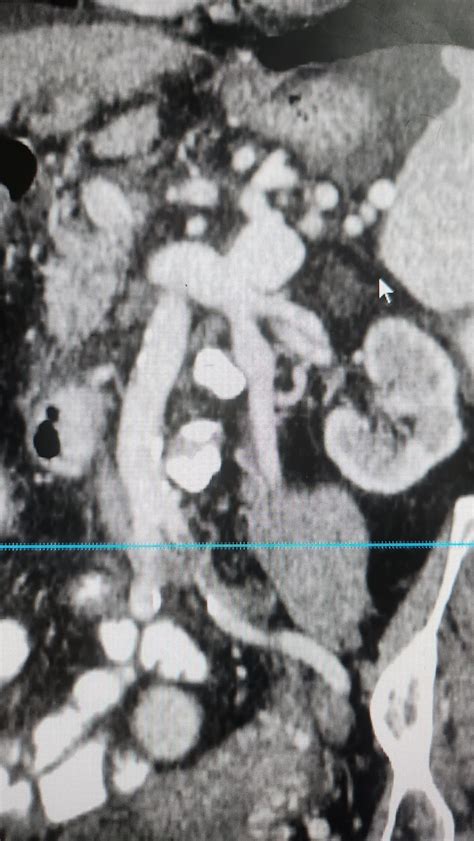 44yo cirrhosis patient with a spontaneous splenorenal shunt. : r/Radiology