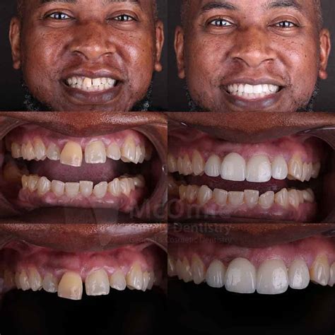 Dental Bridge Front Teeth Before And After