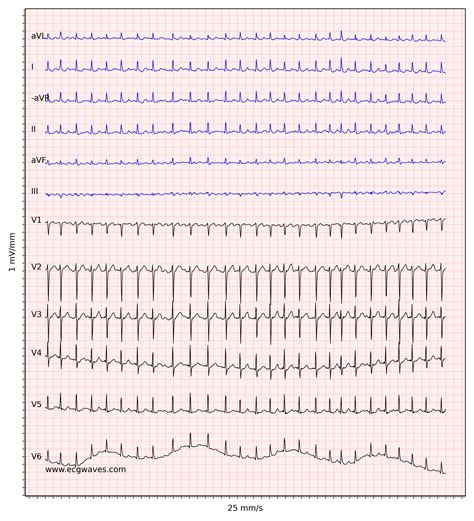 Atrial fibrillation: ECG, classification, causes, risk factors & management – ECG & ECHO