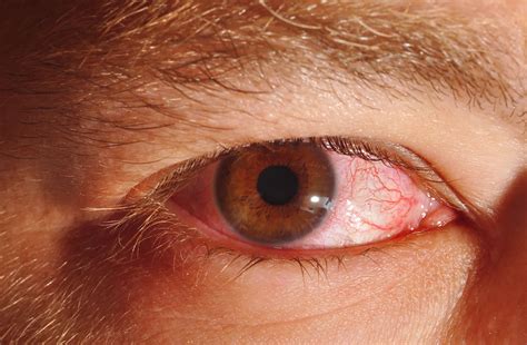 Eye Herpes Symptoms and Treatment