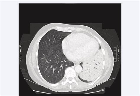 Chest CT scan: increase in the density of the alveolar in fíltrate with... | Download Scientific ...