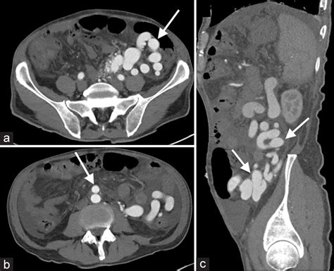 Endovascular treatment of unique colonic arteriovenous malformation with dual supply from ...