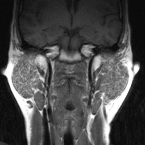 MRI of the parotid glands in a patient with Sjogren's syndrome | Eurorad