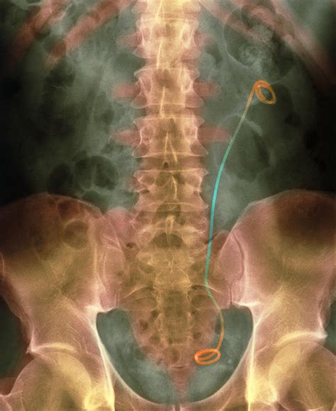 Coloured X-ray Of A Stent Inserted In The Ureter Photograph by - Fine ...