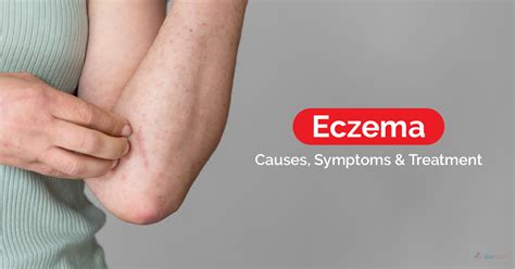 Eczema -Causes,Symptoms & Treatment |Skedoc