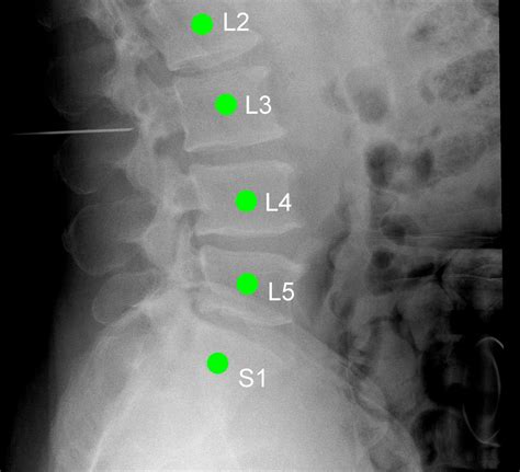 Reducing Spinal Surgery Errors with Software - Rehab Management