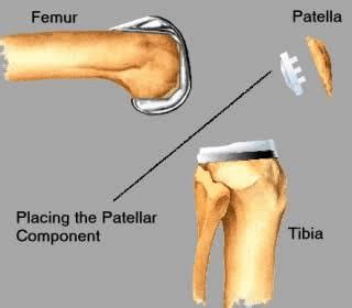 TKR - Knee Cap | Joint Replacement Patient Forum