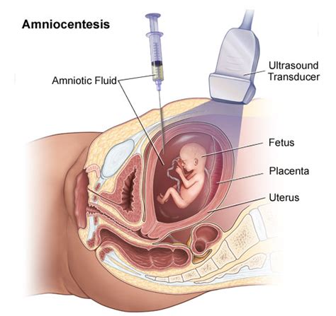 Amniocentesis Diagram