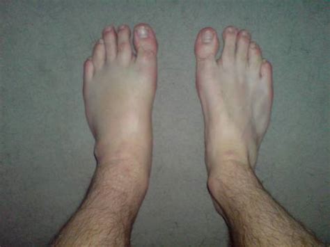 Causes of Unexplained Swelling of Left Foot and Ankle | IYTmed.com