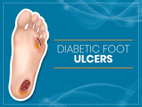 Diabetic Foot Ulcers: Causes, Types, Symptoms, Diagnosis, Treatment ...