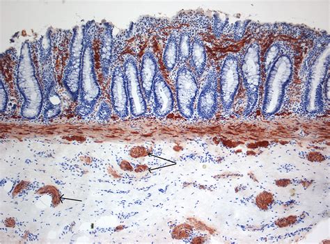 Hirschsprung's disease pathophysiology - wikidoc