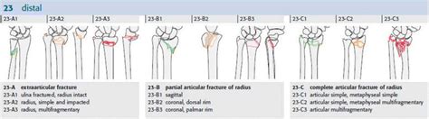 The Müller AO Classification of distal radius fracture. Copyright by AO ...