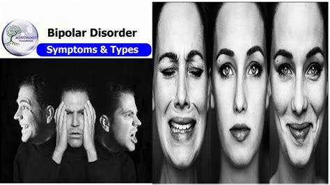 About Bipolar Disorder, Symptoms,Types & Treatment