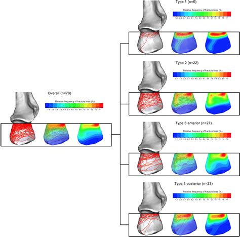 Fracture maps illustrating fracture location in percentage involvement... | Download Scientific ...