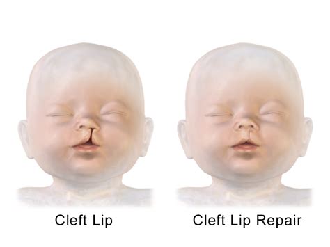 File:Cleft Lip Repair.png - Wikimedia Commons