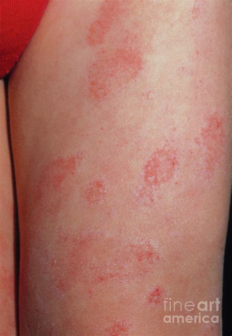 Eczema On The Leg Of A Child Photograph by Dr H.c.robinson/science Photo Library | Fine Art America