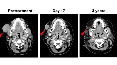 Immunotherapy before surgery could advance care of an aggressive form of skin cancer