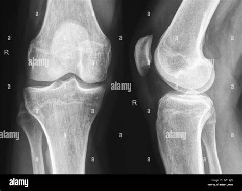 Radiografía de la rodilla derecha Fotografía de stock - Alamy