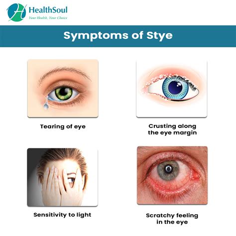 Stye : Causes and Treatment – Healthsoul