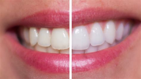 hydrogen peroxide teeth whitening with braces - Teeth whitening kits ...