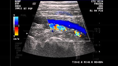 Introduction to the Lower Extremity Venous Doppler Study - YouTube