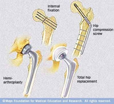 Types of Hip Surgery | eHow