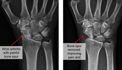 Wrist Arthritis - Raleigh Hand Surgery — Joseph J. Schreiber, MD