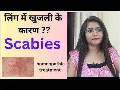 Scabies on the penis ( लिंग में खुजली के कारण ) ! Scabies symptoms,causes & homeopathic medicine ...