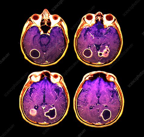 Brain abscesses, MRI scan - Stock Image - M108/0776 - Science Photo Library