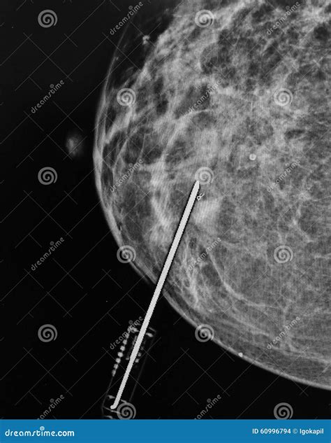 Mammography Biopsy Needle Pathological Zone Stock Photo - Image of examine, pathology: 60996794