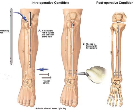 From Diagnosis to Healing: An Expert Guide to Tibia Fractures and Successful Recovery