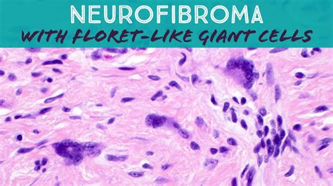 Neurofibroma Histology