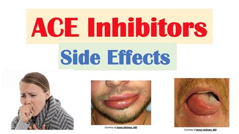 ACE Inhibitor Side Effects: Lisinopril, Ramipril, Captopril, Perindopril | Causes and Why They ...