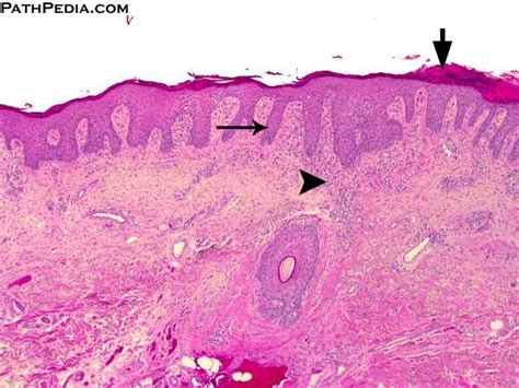 Histopathology images of Psoriasis by PathPedia.com: Pathology e-Atlas