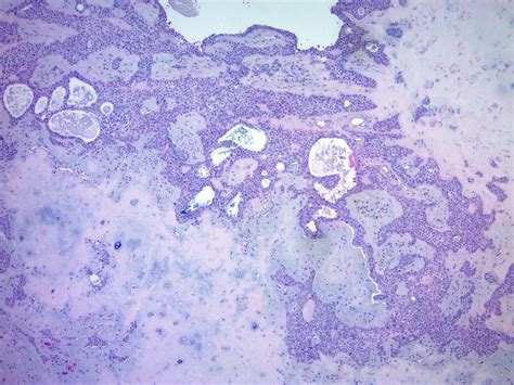 Pathology Outlines - Cutaneous mixed tumor / chondroid syringoma