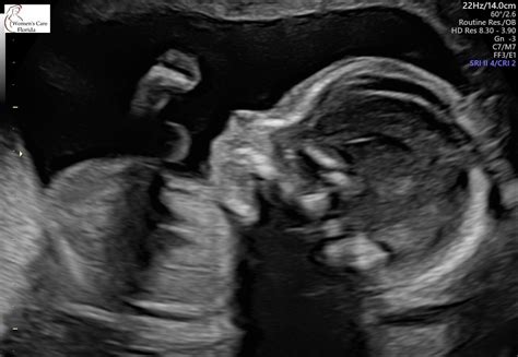 My Pregnancy-The 20 Week Detailed Anatomy Scan