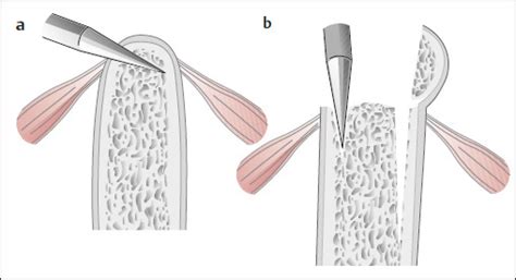 Harvesting Bone Graft from the Iliac Crest | Plastic Surgery Key