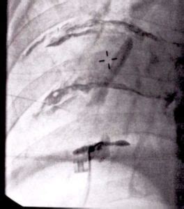 Intercostal Nerve Block - SpinePain Solutions