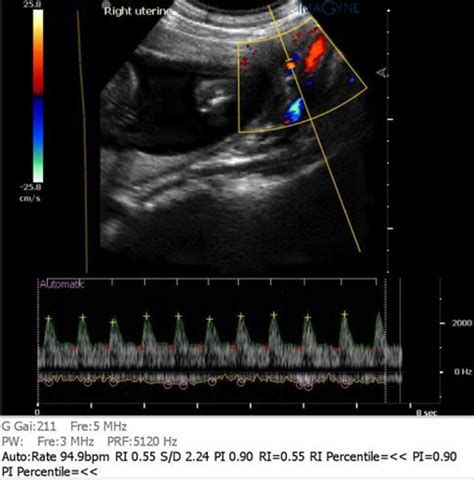 Figure 1 from Uterine artery Doppler study in second trimester of ...