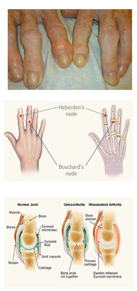 Heberden's nodes images | Bone and joint, Osteoarthritis, Synovial fluid