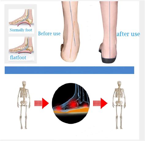 Medical Orthopedic Insoles