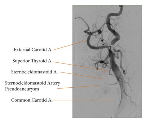 Angiogram of right common carotid and its branches. This figure depicts ...