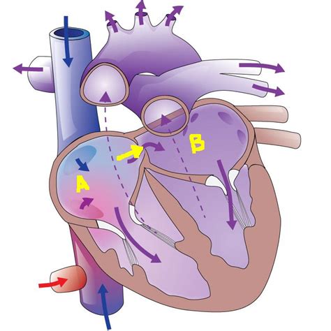 Demystifying the Patent Foramen Ovale (PFO) - The Stroke Blog