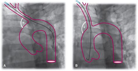 Tips and Tricks for Diagnostic Angiography and Intervention | Thoracic Key