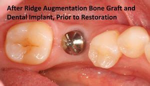 Ridge Augmentation - Fort Collins, CO - Greeley, CO - Bone Grafting