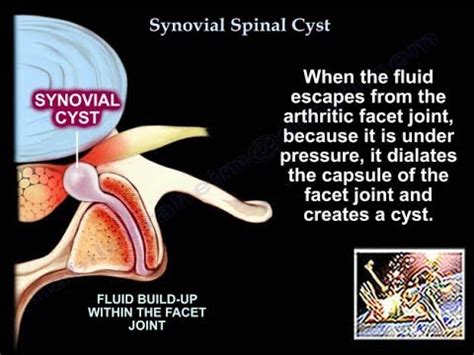 Synovial Cyst Lumbar Spine Removal - mapametawan