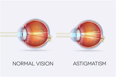 A Complete Guide to Astigmatism: Symptoms, Causes, Diagnosis, and ...