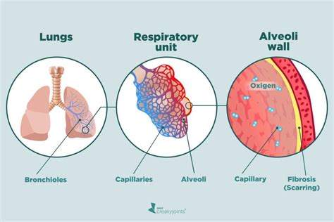 Factors Linked with Increased Risk of Interstitial Lung Disease in Rheumatoid Arthritis